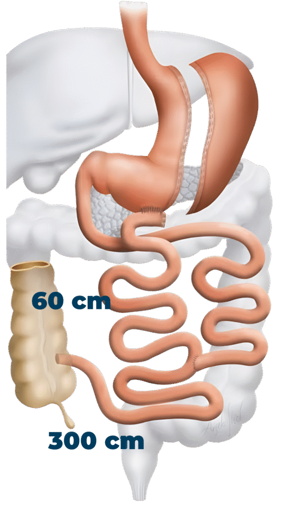 bipartição intestinal em Curitiba cirurgia de bipartição intestinal em Curitiba técnica de bipartição intestinal em Curitiba gastrectomia vertical com bipartição intestinal em Curitiba bypass gástrico em Curitiba cirurgia bypass gástrico em Curitiba sleeve gástrico em Curitiba gastrectomia vertical em Curitiba cirurgia metabólica em Curitiba cirurgia bariátrica em Curitiba cirurgia para o diabetes em Curitiba cirurgia SADI‑S em Curitiba duodenal switch em Curitiba cirurgião bariátrico em Curitiba cirurgião do aparelho digestivo em Curitiba tratamento da obesidade em Curitiba clínica de cirurgia metabólica em Curitiba clínica de cirurgia bariátrica em Curitiba clínica de bipartição intestinal em Curitiba recuperação bipartição intestinal em Curitiba cirurgia revisional em Curitiba melhor cirurgia metabólica em Curitiba cirurgia bariátrica sem desvio intestinal em Curitiba preço cirurgia bipartição intestinal em Curitiba